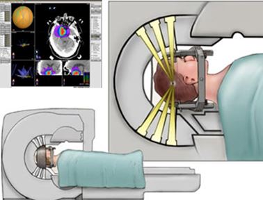 The revolution in treating brain tumours