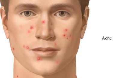 Severe acne: treat without waiting