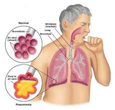 Pneumonia and diarrhoea – diseases to fight togeth